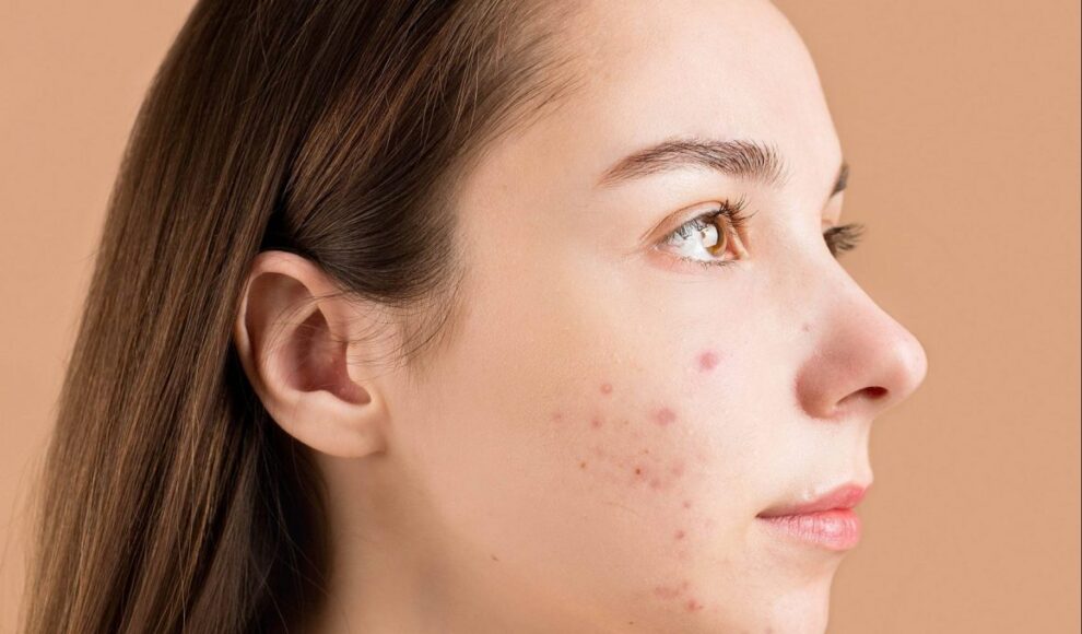 Scopri i migliori consigli e rimedi naturali per prevenire i brufoli nel 2025. Routine skincare, alimentazione e trattamenti efficaci per una pelle sana e senza imperfezioni